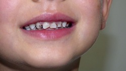 child caries. bad teeth