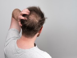 Behind view of a young balding man's head showing clear signs of balding and hair loss around the scalp. Male pattern baldness concept against a clear white background with room for text.