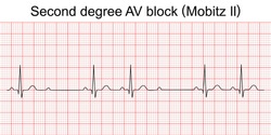 Electrocardiogram show second degree AV block (Mobitz II) pattern. ECG. EKG. Vital sign. Heart beat. Life line. Medical healthcare symbol.