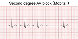 Electrocardiogram show second degree AV block (Mobitz I) or wenckebach pattern. ECG. EKG. Vital sign. Heart beat. Life line. Medical healthcare symbol.