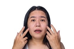 Asian adult woman face has freckles, large pores, blackhead pimple and scars problem from not take care for a long time. Skin problem face isolated white background. Treatment and Skincare concept