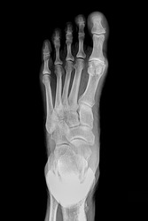 Foot Radiography, in anterior-posterior projection