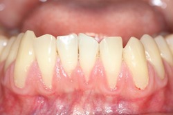 Gingival recession, also known as receding gums, is the exposure in the roots of the teeth caused by a loss of gum tissue and/or retraction of the gingival margin from the crown of the teeth.