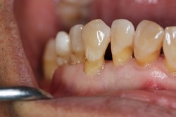 Gingival recession, also known as receding gums, is the exposure in the roots of the teeth caused by a loss of gum tissue and retraction of the gingival margin from the crown of the teeth.
