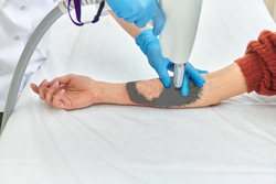 laser tattoo removal on woman's arm