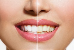 Woman Teeth Before and After Whitening. Over white background. Happy smiling woman. Dental health Concept. Oral Care.