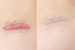 Close up of cyanotic keloid scar caused by surgery and suturing, skin imperfections or defects before and after treatment and laser removal. Hypertrophic Scar on skin, dermatology and cosmetology.