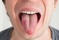Caucasian male exposed tongue with yeast candida infection unrecognizable close up front view.