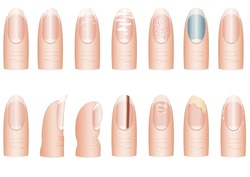 Vector image of fingers with damaged nails. A set of nails with different diseases. Defective nails.