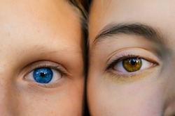 two girls with different eyes touch their cheeks, photo near. The first has a clear blue color, the second has brown, amber, red, yellow, and sparkles under the eye. Like winter and fall or summer.