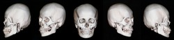 X-ray  scan facial bone 3D of human skull
