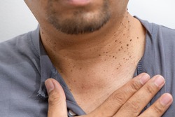 Closed up the Skin Tags or Acrochordon on neck man on white background. Health care concept