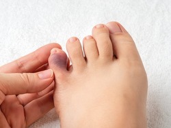 Woman hand touching little toe with purple bruise after home accident. Looking at bruised pinky toe of female person foot. Injury of foot little finger. Broken toe or phalange fracture. Top view.