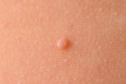 Detail of a molluscum contagiosum nodule produced by the Molluscipoxvirus virus on the skin of the abdomen of a child.