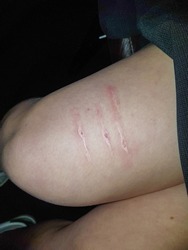 Self Harm Scars and Marks on a School Girl's Legs Above the Knees