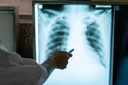 Doctor examines X-ray of a lung In medical laboratory.