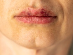 Beautiful woman with a bruise on her lips after lip augmentation with hyaluronic acid. Injection cosmetology concept.
