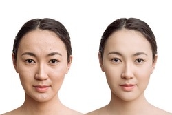 the concept of skin care before, after. young asian woman with bad skin with wrinkles and acne and after with perfect skin. comparison of the result