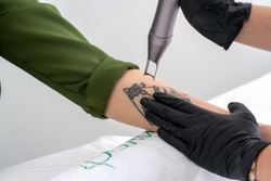 Cosmetologist using laser device to remove an unwanted tattoo from female arm. Concept of erasing tattoos as an expensive procedure in a cosmetology clinic
