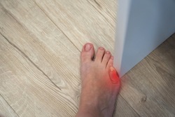 Woman hit furniture with the little toe. Incident at home. Red spot showing injury of foot little finger