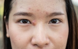 Cropped shot of ugly Asian woman with large pimple (or Elephant head acne) and acne inflamed on her face. Hard pimples develop when dead skin cells, sebum, and bacteria enter the skin's surface.