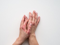 Psoriasis skin. Closeup of rash and scaling on the patient's skin. The concept of chronic disease treatment. Dermatological problems. Hard, horny and cracked skin in woman's hands. Dry skin. Isolated
