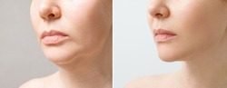 Female double chin before and after correction. Correction of the chin shape liposuction of the neck. The result of the procedure in the clinic of aesthetic medicine.