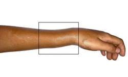 Colles’ fracture or broken wrist in Asian, 7-year-old child. It is a complete fracture of radius bone close to wrist resulting in an upward displacement of the radius. Isolated image with text space.