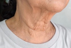 Aging skin folds or skin creases or wrinkles at neck of Southeast Asian, Chinese elderly woman.