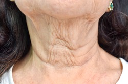 Aging skin folds or skin creases or wrinkles at neck of Southeast Asian, Chinese elderly woman. Front view.