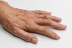 Age spots on hand of Asian elder man. They are brown, gray, or black spots and also called liver spots, senile lentigo, solar lentigines, or sun spots.