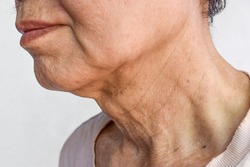 Aging skin folds or skin creases or wrinkles at neck of Southeast Asian, Chinese old man.