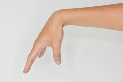 Radial nerve injury or wrist drop of Asian young man.