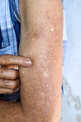 Age spots and white patches on arm of Asian elder man. They are brown, gray, or black spots and also called liver spots, senile lentigo, solar lentigines, or sun spots.