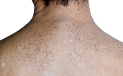 Age spots and white patches on upper back of Asian elder man. They are brown, gray, or black spots and also called liver spots, senile lentigo, solar lentigines, or sun spots.