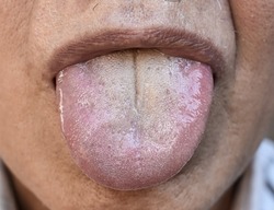 Fissured tongue of Southeast Asian elder man. It is marked by a deep, prominent groove in the middle.