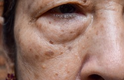Small brown patches called age spots on face of Asian elder woman. They are also called liver spots, senile lentigo, or sun spots. Closeup view.