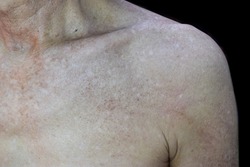 Age spots and white patches on chest of Asian elder man. Age soots are brown, gray, or black spots and also called liver spots, senile lentigo, solar lentigines, or sun spots.