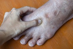 Pitting edema of lower limb. Swollen foot of Asian old man.