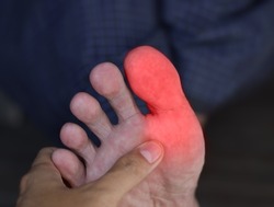 Inflammation in the big toe of Asian man. Concept of foot joint pain, arthritis, stumble, hyperuricema or gout.