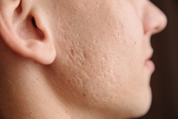 Close-up of problem skin with deep acne scars on a young man's cheek
