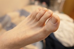 Close-up photo of a male left foot with long toenails and varus big toe.