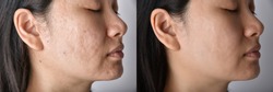 Skin problems and acne scar, Before and after acne facial care treatment, Beauty concept.