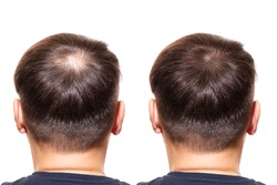 hair loss. Care Concept. transplantation hair. men view from the back, comparison of hair before and after transplantation. bald head.  baldness treatment. medicine. thick healthy hair head        