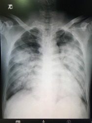 Film chest x-ray PA up right.Show abnormal of lung.ARDS(Acute respiratory distress syndrome) crisis of respiratory syndrome.Need medication for treatment.Medical concept.