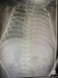 Film X-ray show hight flow pattern of pulmonary vasculature with prominent aortic knob suspected PDA with pulmonary congestion and bilateral pleural effusion for medical and technology concepts 