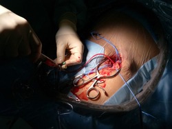 Surgeon was accessed 7 Fr femoral arterial sheath to femoral artery by arterial cutdown technique