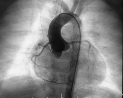 Aortogram of children with tetralogy of fallot disease (TOF) was performed normal aortic root, ascending aorta, left and right coronary artery and aortic arch