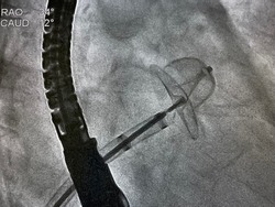 X-ray image performed left atrial appendage occluder device in patient who has thrombus in left atrial appendage (LAA), Left atrial appendage closure procedures.