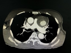 CT scan (computed tomography) of chest and abdominal organs in patient who has aortic dissection at descending aorta.